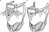 Hyoid Bone Thyroid Suspension Cartilage Advancement Operative sketch template
