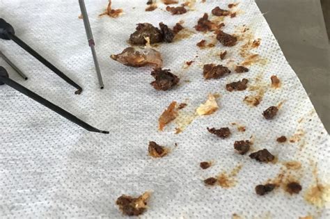 Expert Removes 16 Years Worth Of Built Up Ear Wax In Man S Ear