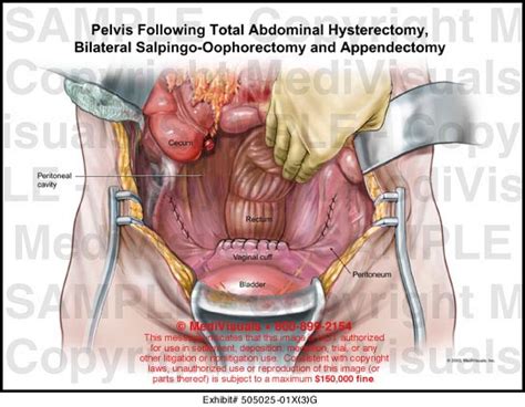 medivisuals pelvis following total abdominal hysterectomy bilateral salpingo oophorectomy and