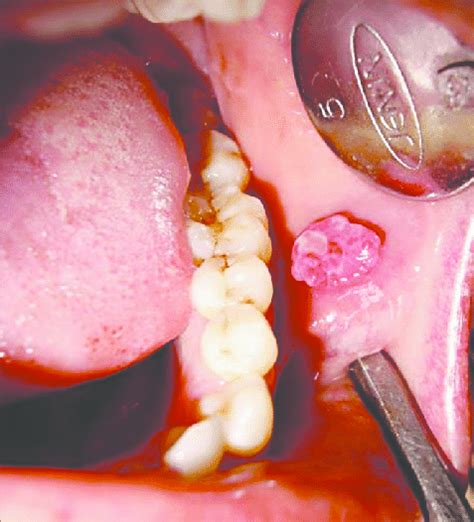 photograph showing  exophytic lesion   left buccal mucosa