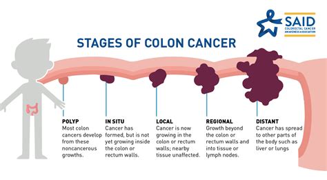 What Is Colon Cancer