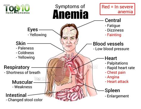recovering  anemia  home remedies top  home remedies