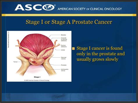 ppt plwc slide deck series understanding prostate