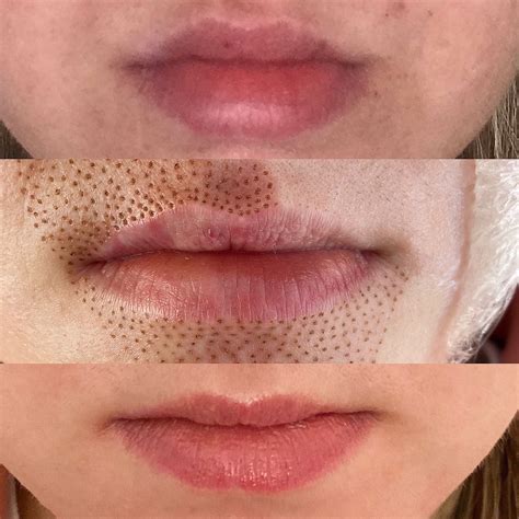 lip flip rejuva skin face treatment dermal fillers