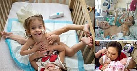 Conjoined Twins Who Faced Each Other Separated In California Surgery