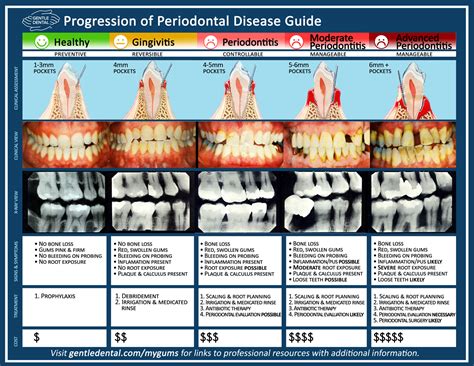 periodontal disease stages