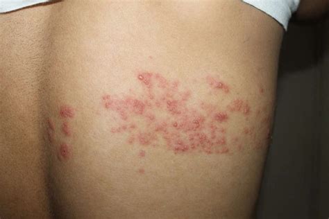 herpes zoster shingles miracle homeo clinic