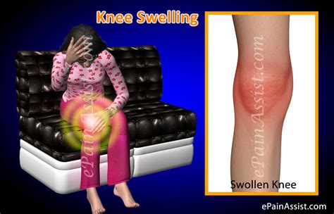 knee swelling or swollen knee