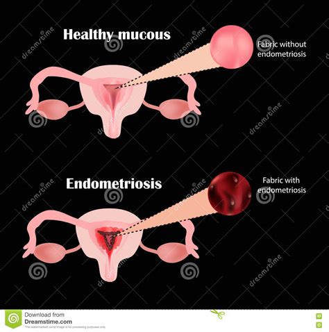 Endometriosis The Structure Of The Pelvic Organs Adenomyosis The