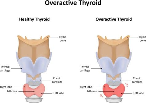 overactive thyroid hyperthyroidism    symptoms