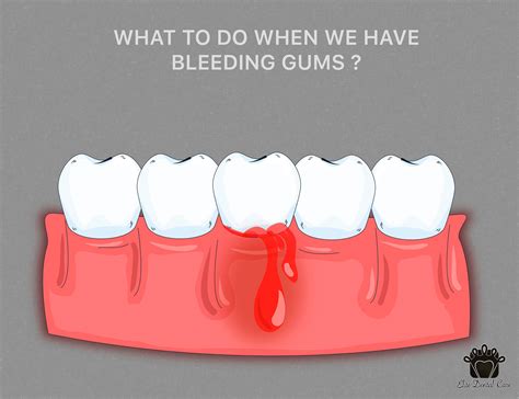 gums  bleeding elite dental care tracy