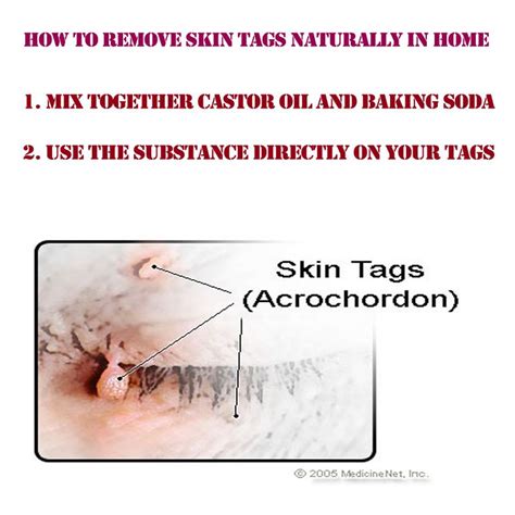 how to remove skin tags naturally from home skin tags remove skin tags naturally skin tags