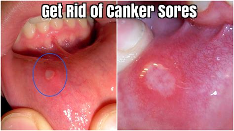 How To Get Rid Of Canker Sores Fast Remedies For Canker Sores