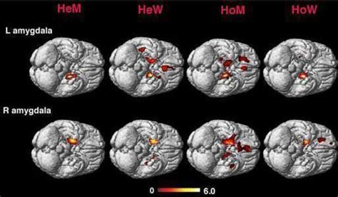 Symmetry Of Homosexual Brain Resembles That Of Opposite Sex