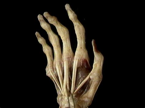 long extrinsic finger flexor muscles acland s video
