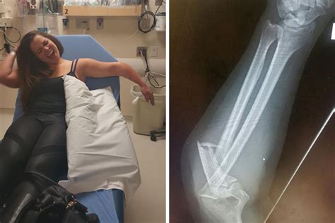 drunk girl has had so much she can t tell how broken her arm is daily
