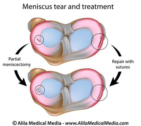 Can Meniscus Tears Heal Without Surgery