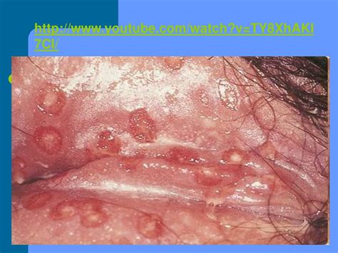 Ppt Herpes Genitalis And Syphilis Powerpoint Presentation Free
