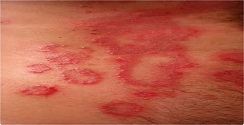 what causes rashes on the skin gleath