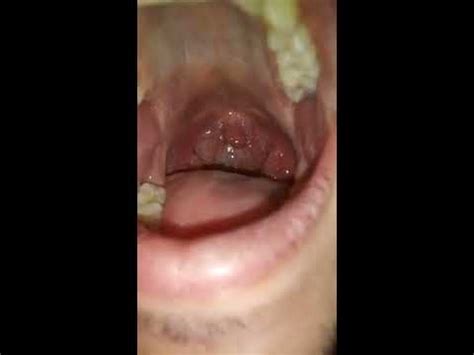 tonsil stone cleaning  removal youtube