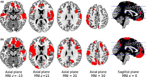 view  schizoaffective disorder brain abnormalities