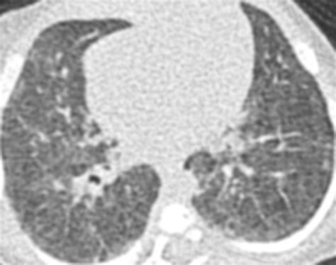 Thin Section Ct Of The Lungs The Hinterland Of Normal Radiology
