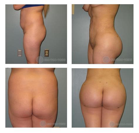 butt augmentation pictures singles and sex