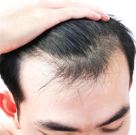 stress  hair loss cosmedica clinic dr levent acar