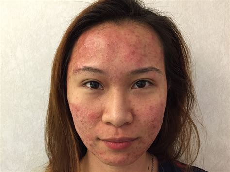 dr gerard ee clifford agnes  permanent cure  adult acne pimples