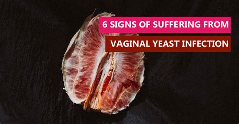 Signs Suffering From Vaginal Yeast Infection Health Tips