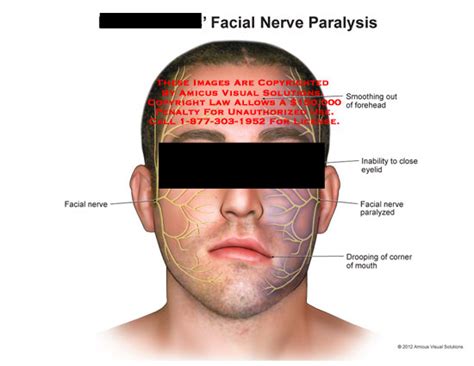 facial nerve droopy mouth porn pictures