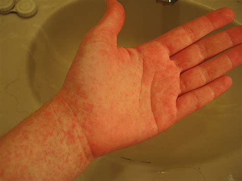 Scarlet Fever Rash Symptoms Pictures Causes Symptoms Treatment