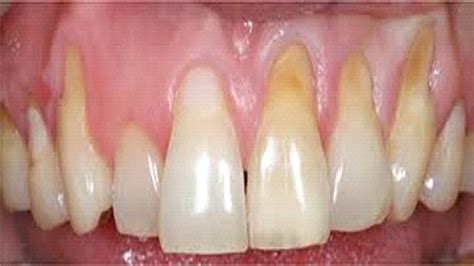 holes  teeth    cavities lyons creek dental care