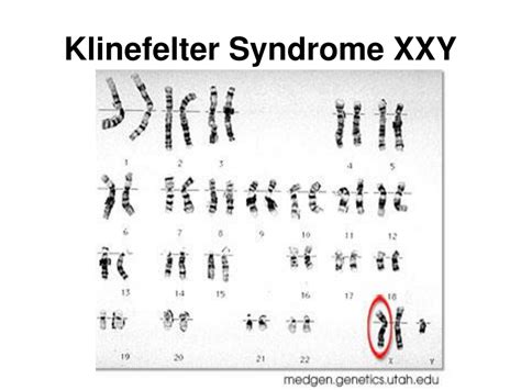 Ppt Karyotypes And Chromosomal Disorders Powerpoint Presentation Free