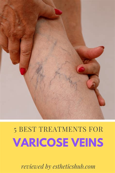 🥇 5 Best Varicose Vein Creams Reviewed 2021 These Will Help You