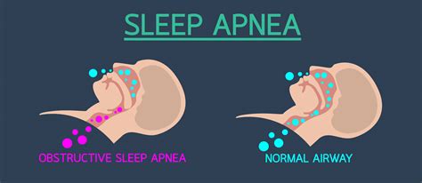 Is Being Overweight Putting You At Risk Of Sleep Apnoea Newls