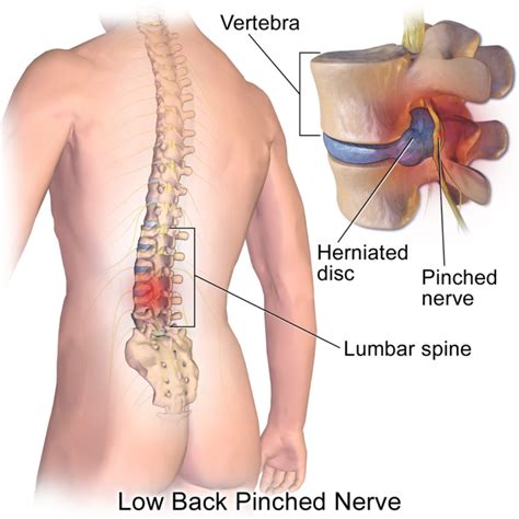 is chiropractic or a massage better for pinched nerves