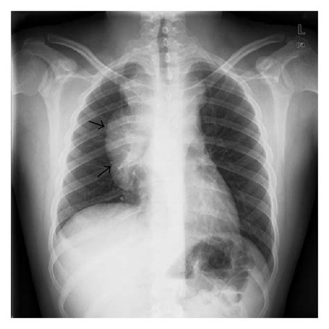Chest Radiograph At Initial Presentation Showing Large Right Hilar Mass
