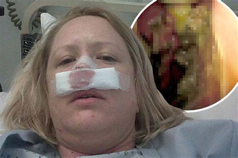 flesh eating disease made actress sneeze off her nose