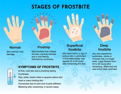 frostbite symptoms  cold           fast