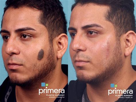 facial scarring    pictures case  orlando florida primera plastic surgery