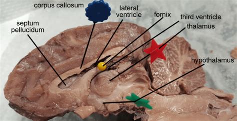 brain corpus callosum  ventricles