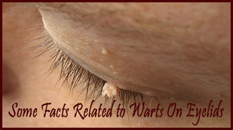 warts on eyelid know its causes symptoms facts