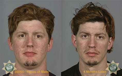 Horrifying Before And After Photos Of Meth Users Mother Jones