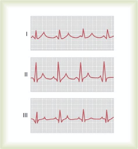 How To Read A Normal Ecg Electrocardiogram Hubpages