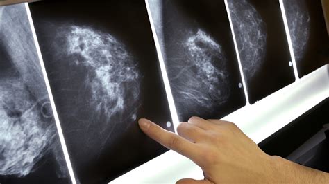 got dense breasts that can depend on who is reading the mammogram shots health news npr