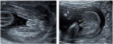 Discordant Fetal Sex On Nipt And Ultrasound Smet 2020 Prenatal