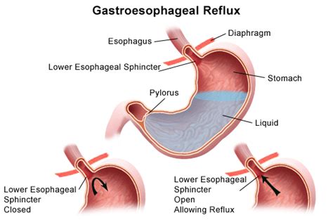 gastroesophageal reflux disease gerdheartburn  children