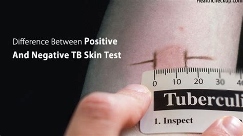 positive tb skin test