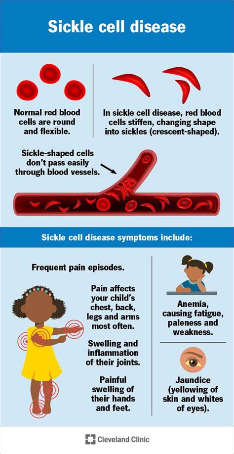 sickle cell symptoms  complications
